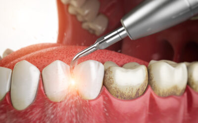 Waarom is het belangrijk om tandsteen te verwijderen?