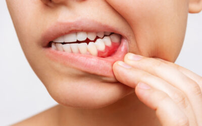 Wij kunnen u helpen bij een tandvleesaandoening